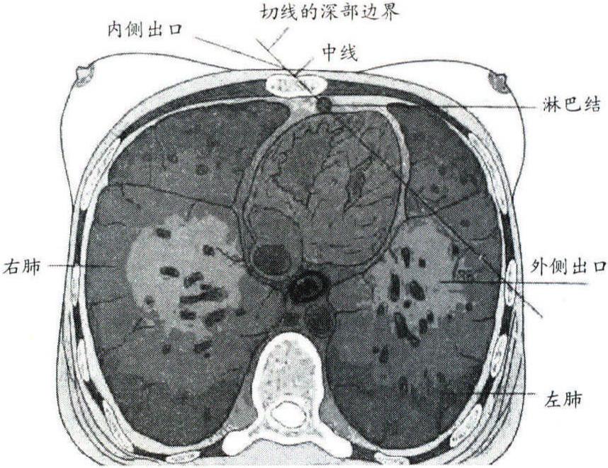 第六節(jié) 乳腺癌放療并發(fā)癥及防治